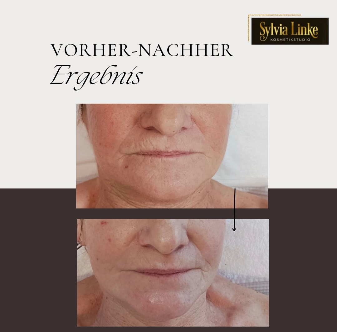 Microneedling vorher nachher